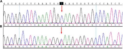 Clinical and Genetic Analysis of a Patient With Coexisting 17a-Hydroxylase/17,20-Lyase Deficiency and Moyamoya Disease